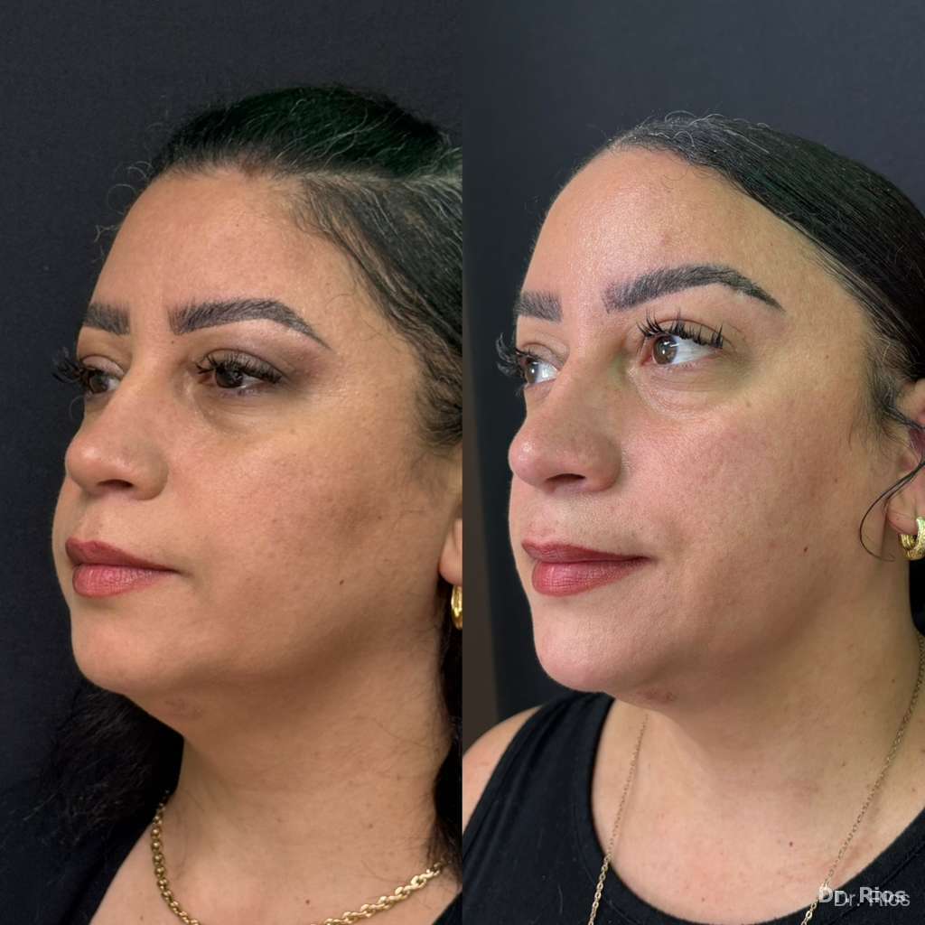 Facial harmonization before and after result