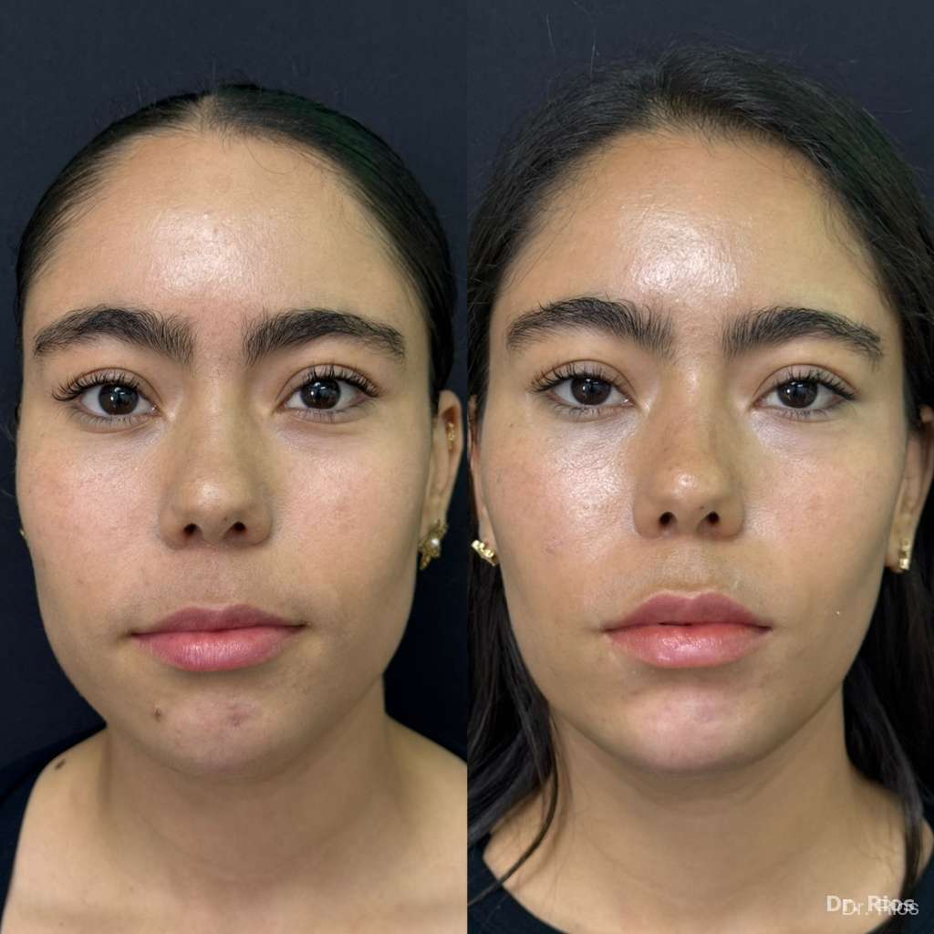 Facial rejuvenation before and after result