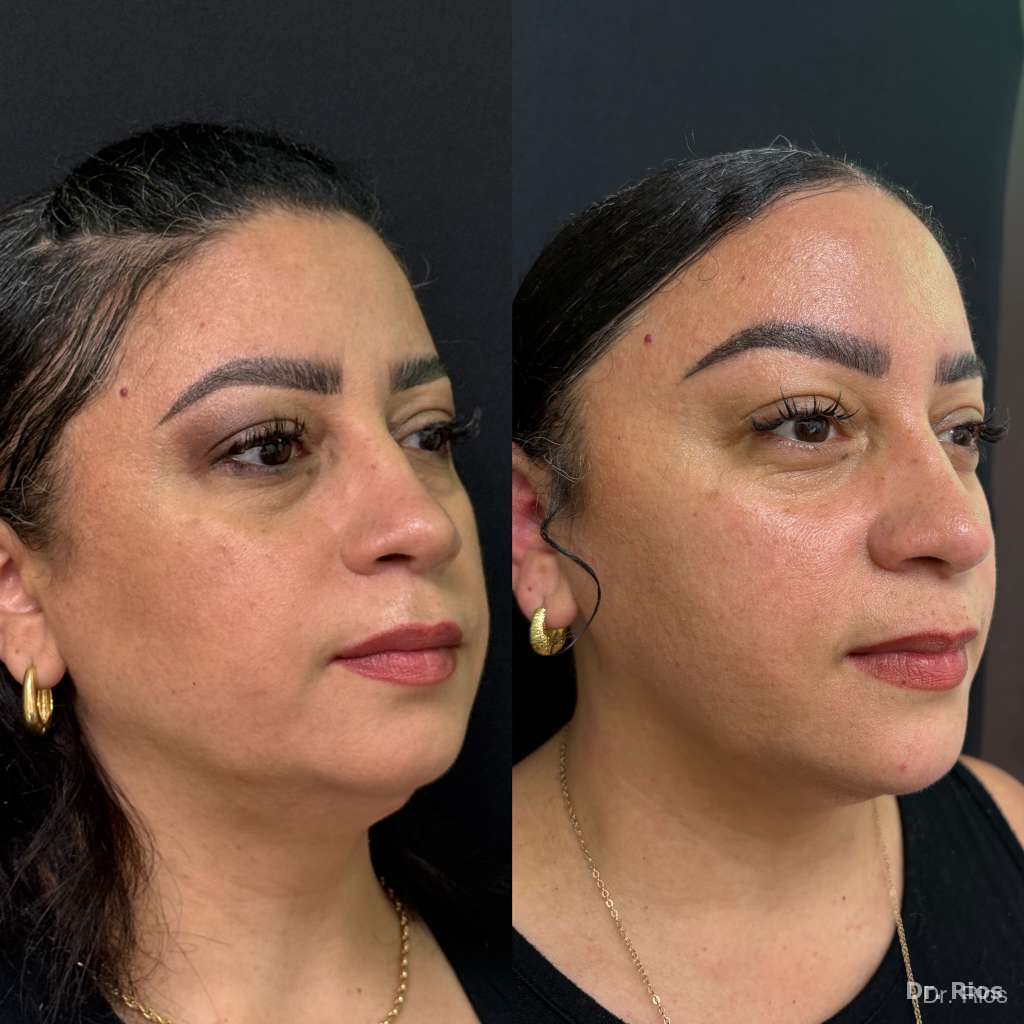 Facial rejuvenation before and after result