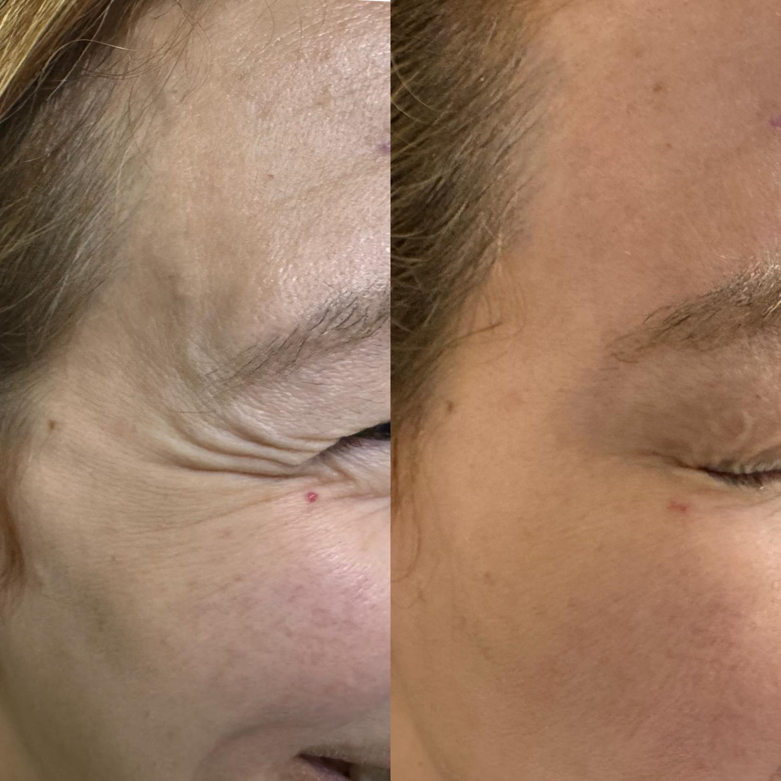 Botox for crow's feet before and after