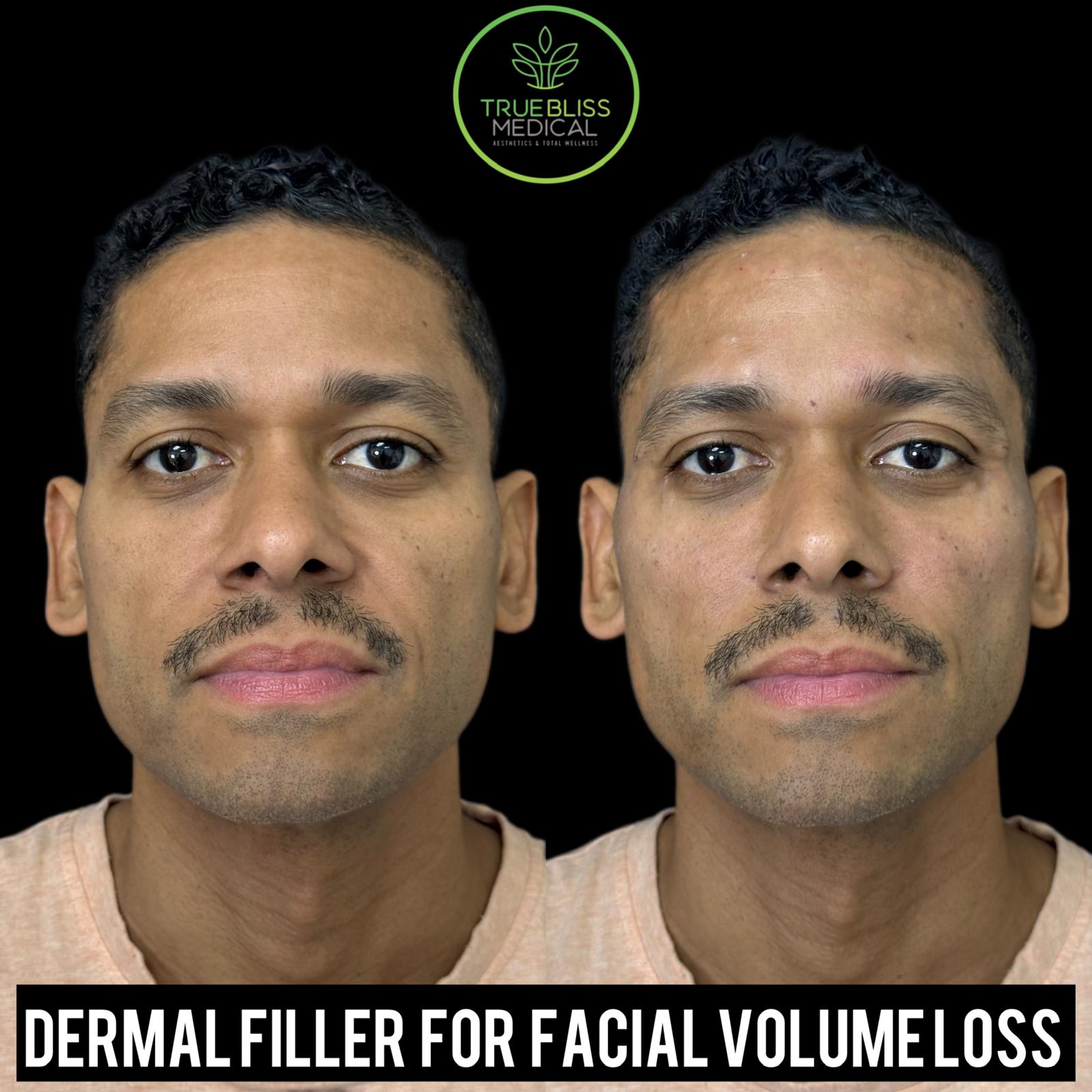 Dermal filler for facial volume loss before and after