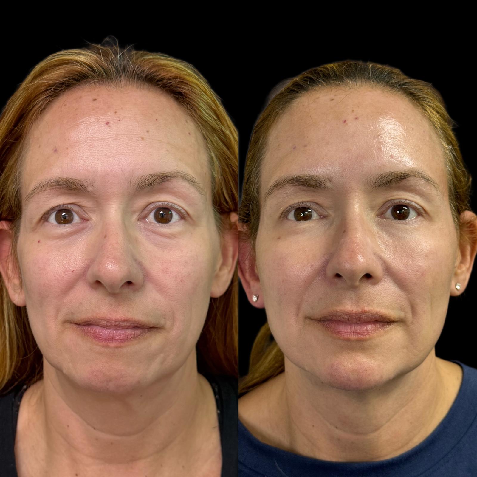 Facial volume loss before and after