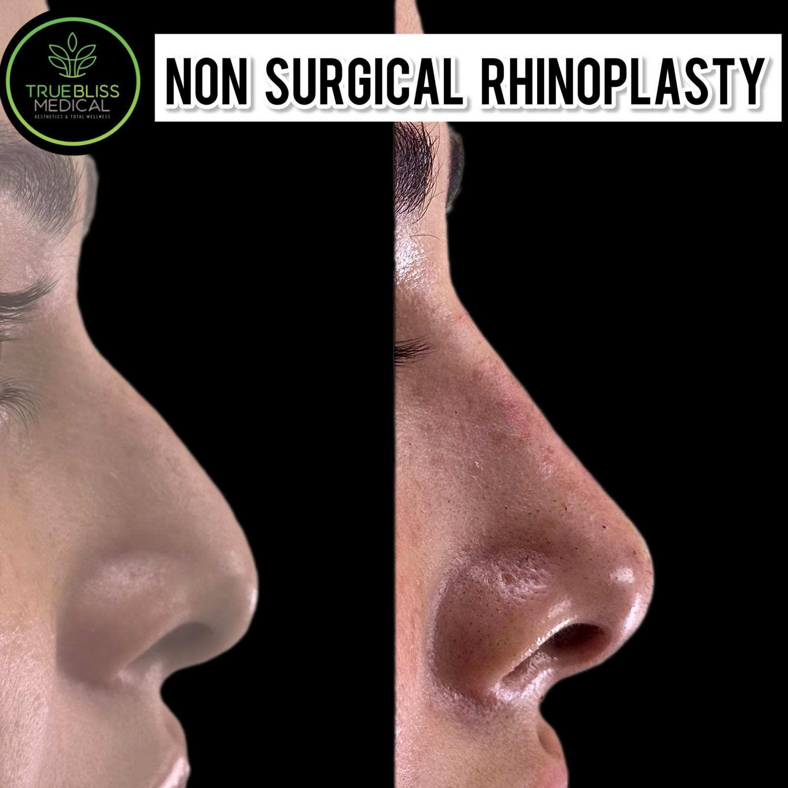 Non-surgical rhinoplasty before and after