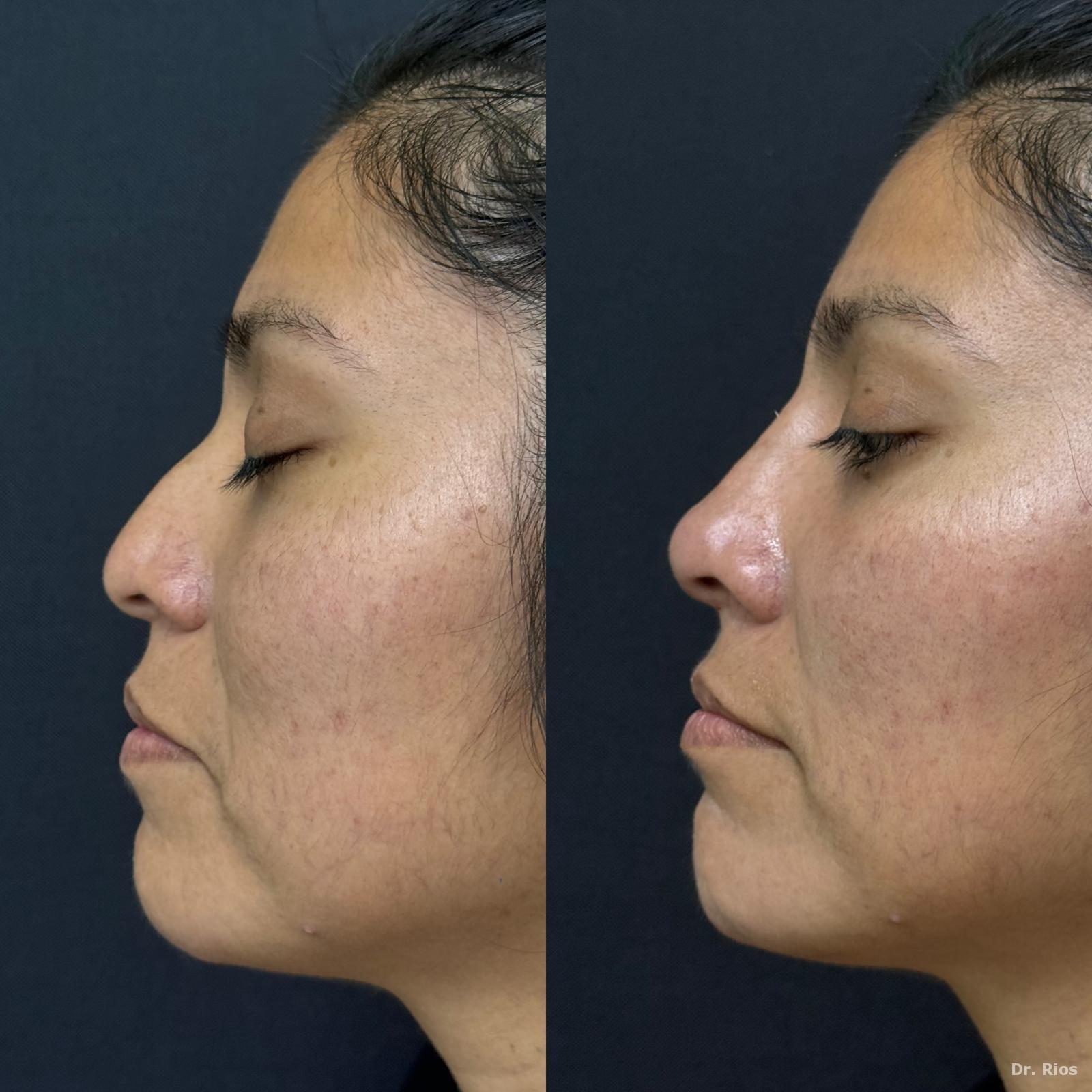 Nose and chin balancing before and after
