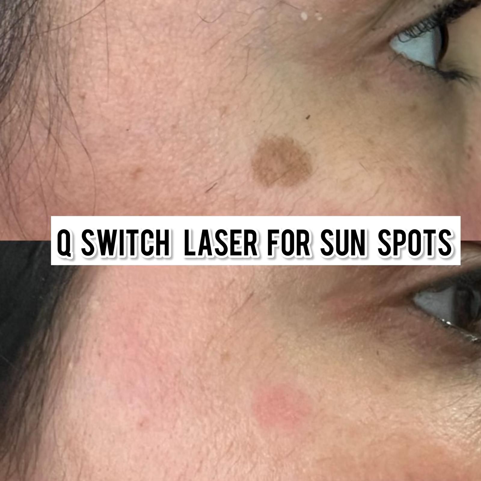 Q-Switch laser for sun spots before and after