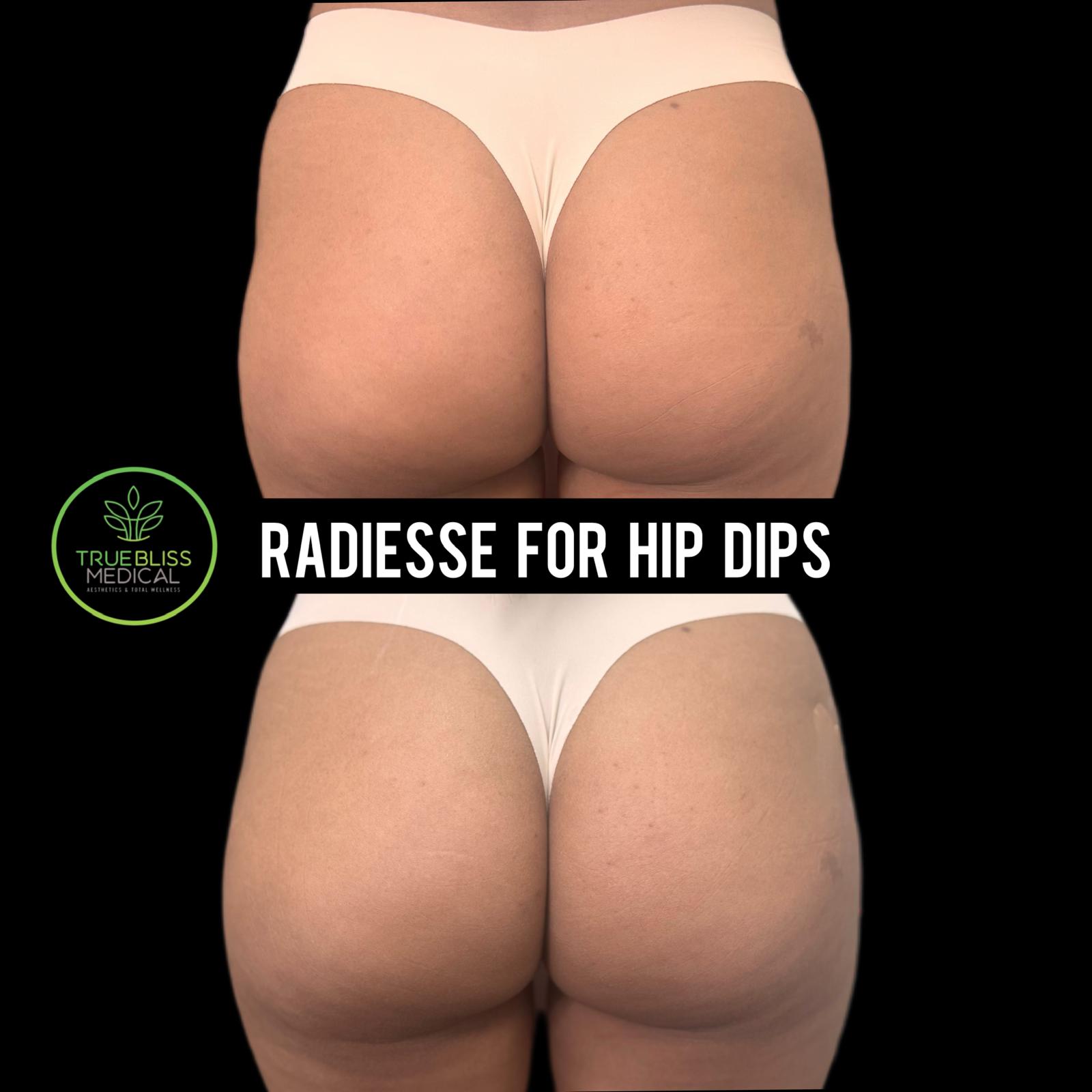 Radiesse for hip dips before and after
