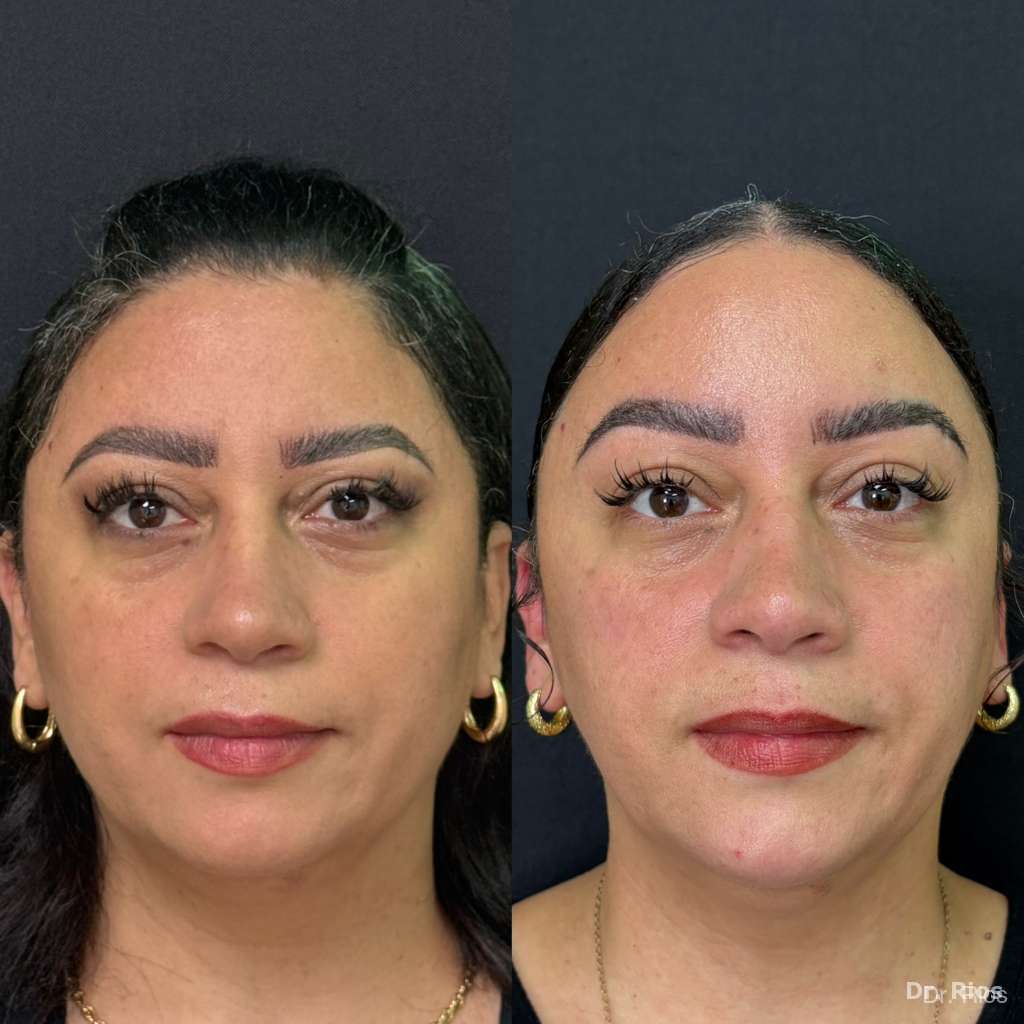 Facial rejuvenation before and after result